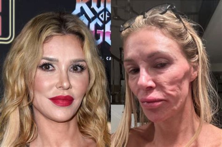 Brandi Glanville finally admits she’s ‘over-filled & had some bad Botox’