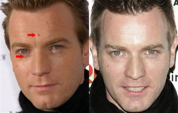 Ewan McGregor in skin cancer scare