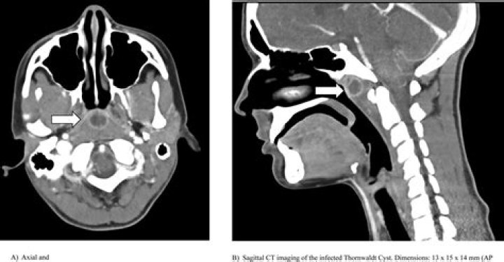 Is a Thornwaldt cyst dangerous?