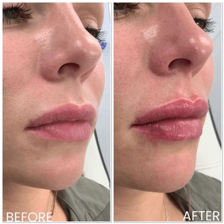 Kylie Jenner claims she’s let her lip fillers ‘dissolve’… but does it happen overnight??