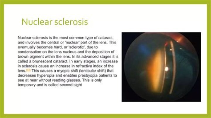 What is nuclear sclerosis of the eyes?